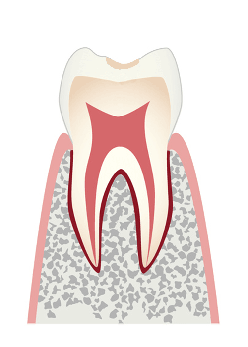 cOごく初期の虫歯
