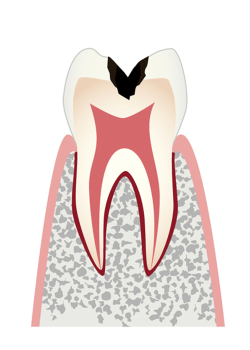 c2歯の内部（象牙質）まで進行した虫歯