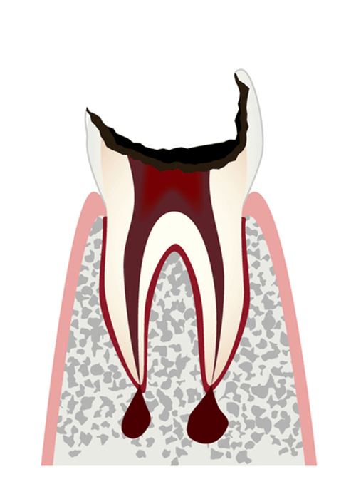 c4歯根まで進行した虫歯