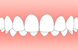 過蓋咬合・かがいこうごう